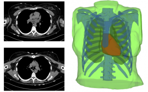 CTscan-Mesh