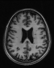 research_MS_MRI