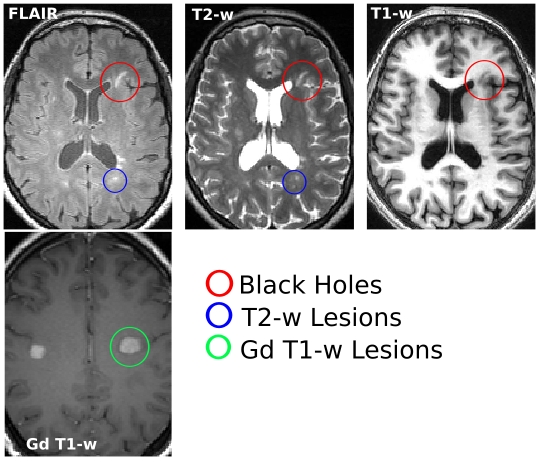 ms mri brain scan results